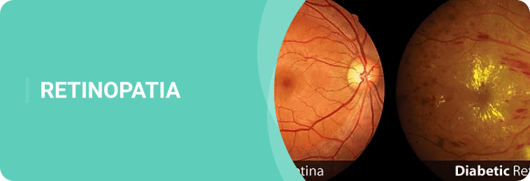 RETINOPATIA